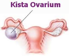 Obat Herbal Kista Ovarium
